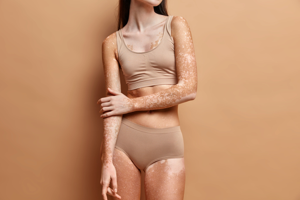 close-up-on-slim-woman-with-vitiligo-skin.jpg